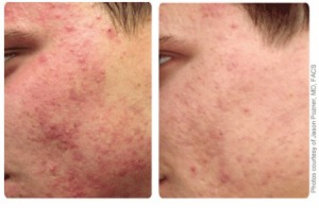 Acne 300x196